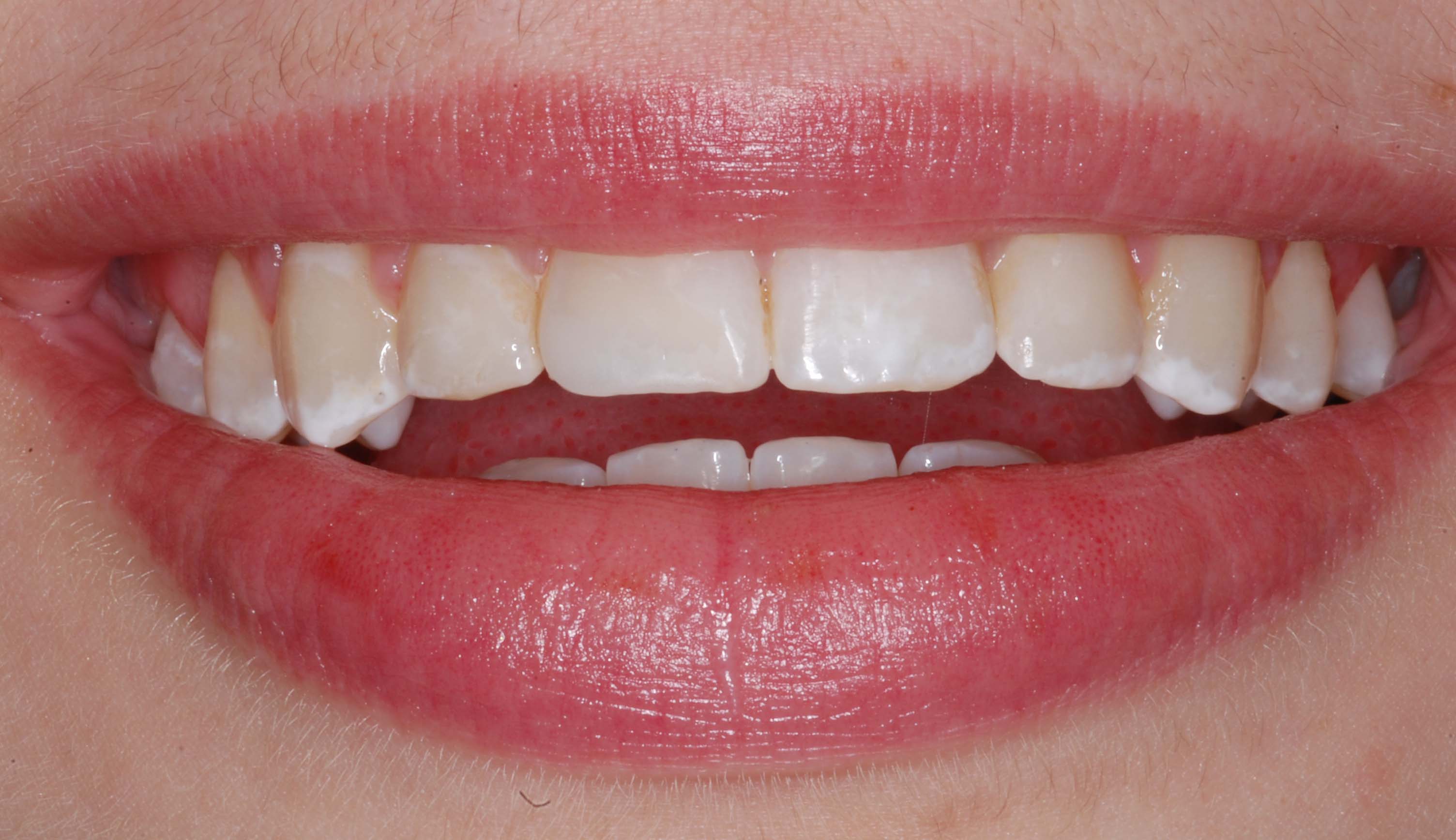 Composite Bonding2 After