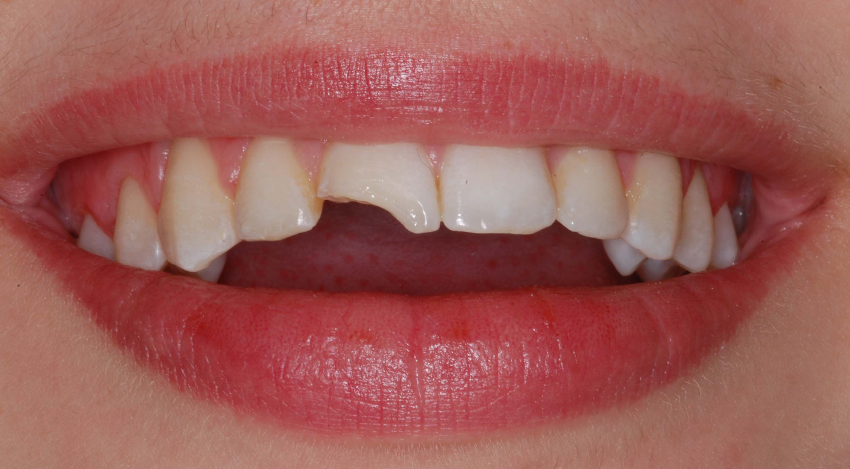 Composite Bonding2 Before