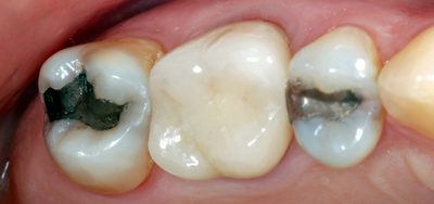 E4D After All Ceramic Crown