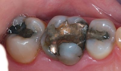 Large Amalgam before E4D All Ceramic Crown