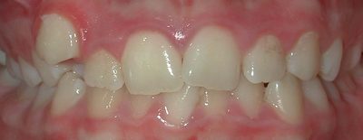 Orthodontic, Braces Crowding Before Photo