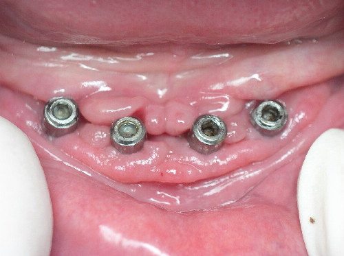 implant