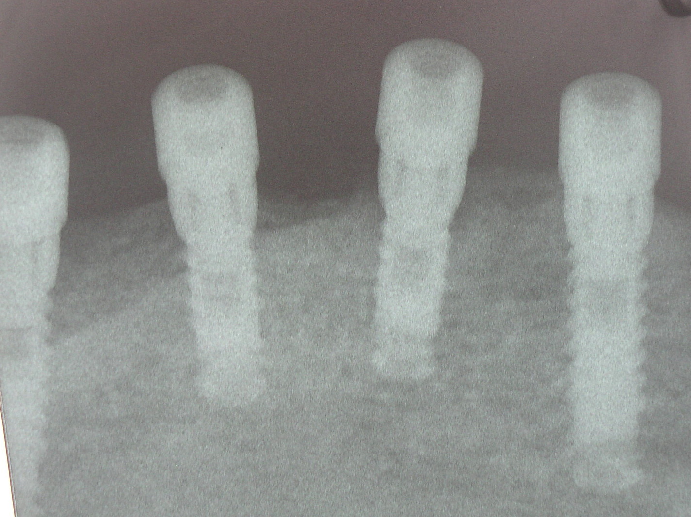 dental implants