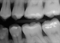 Digital Xrays Walls Street Dentist, Wall Street Manhattan dentist, Dr, Chillura, Wall Street Smile Makeovers
