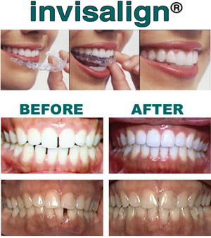 Invisalign at Capital Smiledocs Dental 