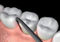 Laser Gum Surgery Video