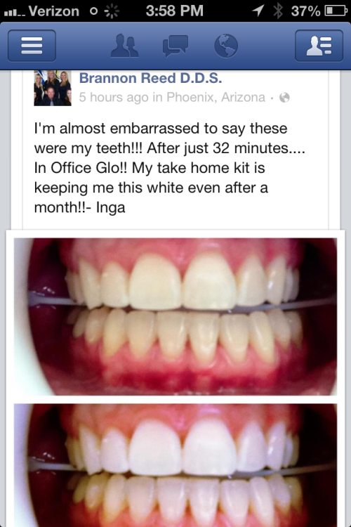 Benjamin W. Stark, DDS - Glo Teeth Whitening