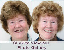 dental implants