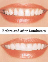 Lumineers - Perfect Smiles Dentistry Westport, Seekonk, Fall River, New Beford, MA, Providence, RI
