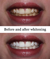 Teeth Whitening - Perfect Smiles Dentistry Serving Westport, Seekonk, Fall River, New Bedford, MA, Providence, RI