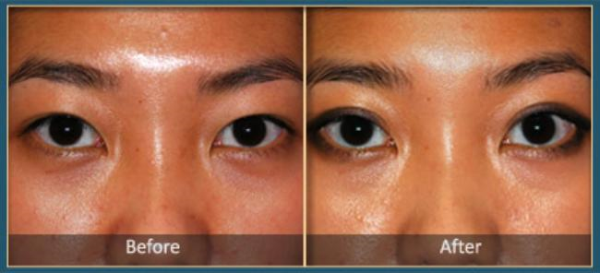 eye-5-bna_blepharoplasty2.jpg